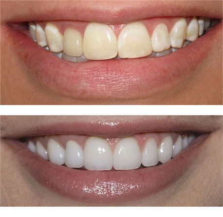Porcelain Veneers near Templestowe