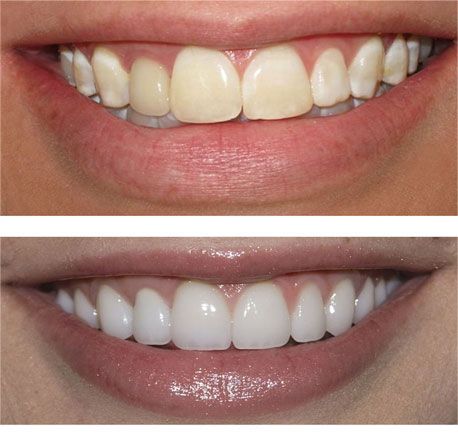 Porcelain Veneers near Templestowe Lower