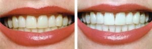 Teeth Whitening [suburb]