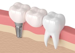 dental bridge service bulleen