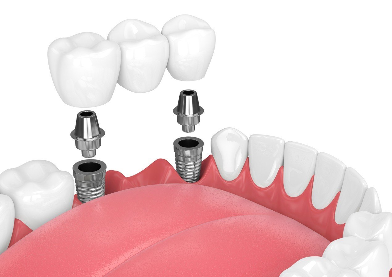 Dental Bridges in Bulleen & Eltham | Evercare Dental Group
